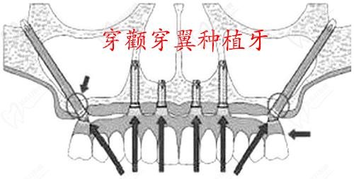 穿顴穿翼種植牙費用完整拆解|術前 CT 檢查與定制方案決定手術成功率與長期效果