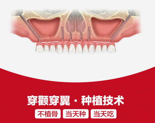 穿顴穿翼種植是否屬於專利壟斷技術?深圳鵬程口腔醫師團隊熟練開展該項高難度種植