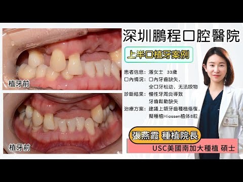 穿顴穿翼種植牙術後注意事項|深圳鵬程口腔高難種植術後護理須知