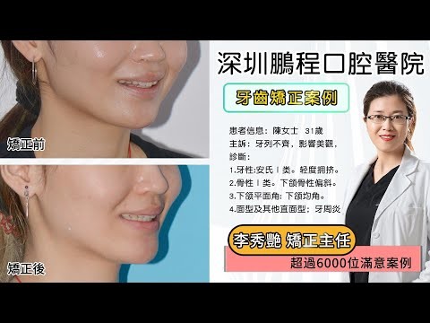 箍牙優選深圳鵬程口腔李秀艷主任