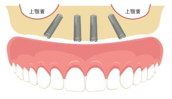 穿顴穿翼種植是專利壟斷技術嗎？深圳鵬程口腔熟練開展高難度種植
