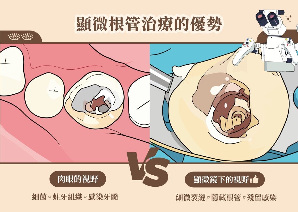 杜牙根再治療優選顯微根管治療 | 深圳鵬程口腔