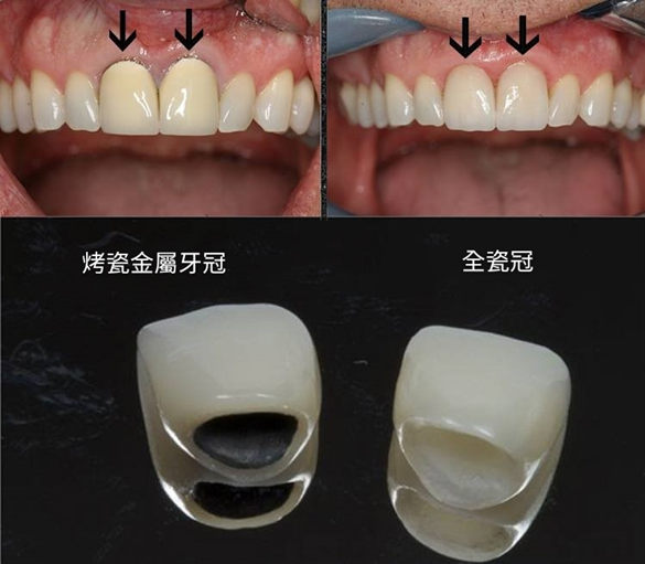 金屬牙VS金屬牙冠邊款好 | 詳解牙冠材質品牌特點